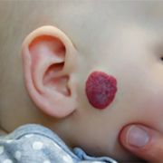 Infantile hemangioma in a 6 month old girl